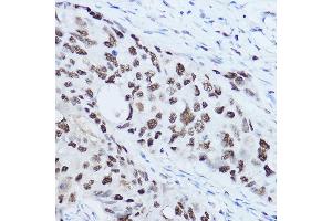 Immunohistochemistry of paraffin-embedded human breast cancer using SSB Rabbit pAb (ABIN3015264, ABIN3015265, ABIN3015266 and ABIN6213909) at dilution of 1:300 (40x lens). (SSB Antikörper  (AA 166-408))