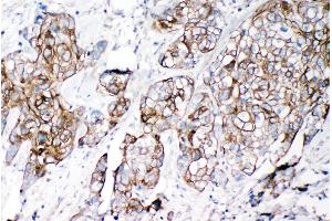 Anti-VE Cadherin antibody, IHC(P) IHC(P): Human Lung Cancer Tissue