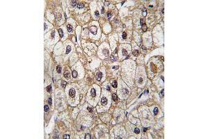 Formalin-fixed and paraffin-embedded human hepatocarcinoma tissue reacted with CYP2C9 antibody (Center), which was peroxidase-conjugated to the secondary antibody, followed by DAB staining. (CYP2C9 Antikörper  (AA 235-265))