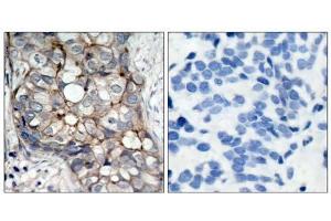 Immunohistochemical analysis of paraffin- embedded human breast carcinoma tissue using (EGFR Antikörper)