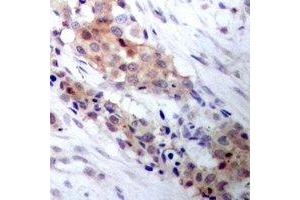 Immunohistochemical analysis of CRY1 staining in human breast cancer formalin fixed paraffin embedded tissue section.