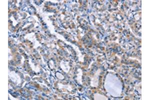 The image on the left is immunohistochemistry of paraffin-embedded Human thyroid cancer tissue using (LRRK2 Antibody) at dilution 1/20, on the right is treated with fusion protein. (LRRK2 Antikörper)