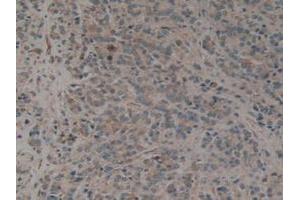 IHC-P analysis of Human Prostate Gland Cancer Tissue, with DAB staining. (CALU Antikörper  (AA 20-315))
