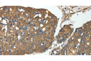 Immunohistochemistry of paraffin-embedded Human breast cancer using MSN Polyclonal Antibody at dilution of 1:30 (Moesin Antikörper)