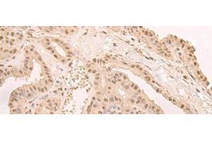 Immunohistochemistry of paraffin-embedded Human thyroid cancer tissue using CNOT10 Polyclonal Antibody at dilution of 1:50(x200) (CNOT10 Antikörper)