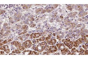 ABIN6272371 at 1/100 staining Human liver cancer tissue by IHC-P. (OR2C3 Antikörper)