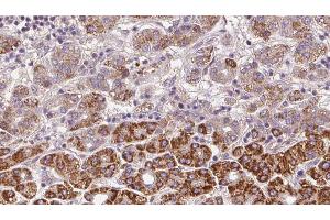 ABIN6272371 at 1/100 staining Human liver cancer tissue by IHC-P.