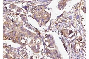 ABIN6269037 at 1/100 staining Human breast cancer tissue by IHC-P. (EPH Receptor A4 Antikörper  (Internal Region))