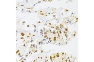 Immunohistochemistry of paraffin-embedded human breast cancer using HNRNPA1 Antibody (ABIN5975570) at dilution of 1/100 (40x lens). (HNRNPA1 Antikörper)