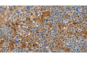 Immunohistochemistry of paraffin-embedded Human liver cancer tissue using HTRA3 Polyclonal Antibody at dilution 1:45 (HTRA3 Antikörper)