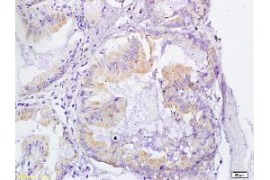 Formalin-fixed and paraffin embedded human gastric cancer  labeled with Anti-VEGFR3 Polyclonal Antibody, unconjugated  (ABIN678578) at 1: 200 followed by incubation with conjugated secondary antibody and DAB staining