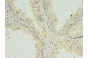 Immunohistochemistry of paraffin-embedded human prostate cancer using ABIN7156699 at dilution of 1:100 (PRKRA Antikörper  (AA 1-313))