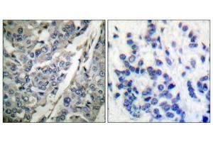 Immunohistochemical analysis of paraffin-embedded human breast carcinoma tissue using Synaptotagmin (phospho-Thr202) antibody (left)or the same antibody preincubated with blocking peptide (right). (SYT1 Antikörper  (pThr202))