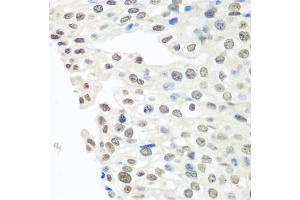Immunohistochemistry of paraffin-embedded human prostate cancer using TARDBP antibody. (TARDBP Antikörper)