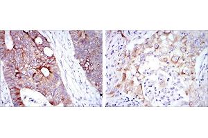 Immunohistochemical analysis of paraffin-embedded rectum cancer tissues (left) and lung cancer tissues (right) using KRT19 mouse mAb with DAB staining.