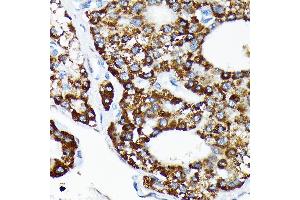Immunohistochemistry of paraffin-embedded human liver cancer using HSP Rabbit mAb (ABIN7267580) at dilution of 1:100 (40x lens). (HSPA4 Antikörper)