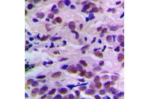 Immunohistochemical analysis of CDK2 (pT160) staining in human breast cancer formalin fixed paraffin embedded tissue section. (CDK2 Antikörper  (pSer160))