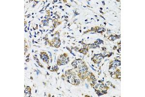 Immunohistochemistry of paraffin-embedded human breast cancer using SSBP1 antibody (ABIN5974202) at dilution of 1/100 (40x lens). (SSBP1 Antikörper)