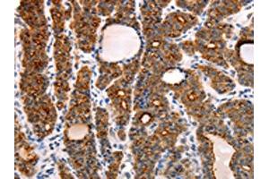 The image on the left is immunohistochemistry of paraffin-embedded Human thyroid cancer tissue using ABIN7130808(RAMP1 Antibody) at dilution 1/10, on the right is treated with fusion protein. (RAMP1 Antikörper)