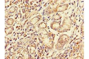 Immunohistochemistry of paraffin-embedded human gastric cancer using ABIN7158537 at dilution of 1:100 (FCGR2A Antikörper  (AA 241-317))