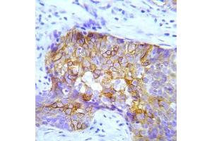 Immunohistochemical analysis of paraffin-embedded human lung adenocarcinoma tissue using Crk2 (Phospho-Try221) Antibody (E012070). (CDK6 Antikörper  (pTry221))