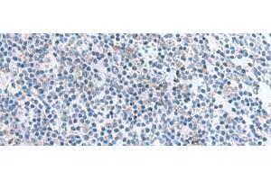 Immunohistochemistry of paraffin-embedded Human tonsil tissue using IL1B Polyclonal Antibody at dilution of 1:55(x200) (IL-1 beta Antikörper)