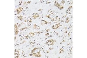 Immunohistochemistry of paraffin-embedded human gastric cancer using DMAP1 antibody (ABIN6003515) at dilution of 1/100 (40x lens). (DMAP1 Antikörper)