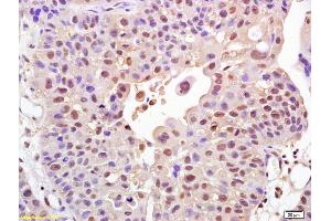 Formalin-fixed and paraffin embedded human bladder carcinoma labeled with Rabbit Anti FOXO1A Polyclonal Antibody, Unconjugated (ABIN1387620) at 1:200 followed by conjugation to the secondary antibody and DAB staining