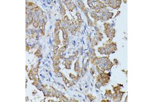 Immunohistochemistry of paraffin-embedded human thyroid cancer using HAL antibody (ABIN6130467, ABIN6141593, ABIN6141594 and ABIN6216851) at dilution of 1:100 (40x lens). (HAL Antikörper  (AA 1-200))