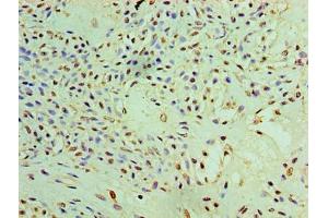Immunohistochemistry of paraffin-embedded human breast cancer using ABIN7166888 at dilution of 1:100 (PYCR1 Antikörper  (AA 2-319))