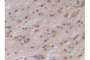 IHC-P analysis of Human Glioma Tissue, with DAB staining. (NOTCH4 Antikörper  (AA 1715-2001))