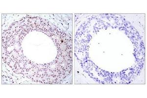 Immunohistochemical analysis of paraffin-embedded human breast carcinoma tissue using NFkB-p65(Phospho-Thr254) Antibody(left) or the same antibody preincubated with blocking peptide(right). (NF-kB p65 Antikörper  (pThr254))