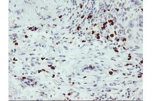 Immunohistochemical staining of paraffin-embedded Carcinoma of Human lung tissue using anti-PADI4 mouse monoclonal antibody.