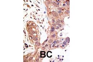 Formalin-fixed and paraffin-embedded human cancer tissue reacted with the SENP1 polyclonal antibody  , which was peroxidase-conjugated to the secondary antibody, followed by AEC staining.