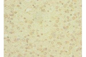 Immunohistochemistry of paraffin-embedded human glioma using ABIN7166564 at dilution of 1:100 (PCDH19 Antikörper  (AA 568-678))
