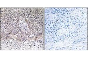Immunohistochemistry analysis of paraffin-embedded human cervix carcinoma tissue, using ARSA Antibody. (Arylsulfatase A Antikörper  (AA 251-300))