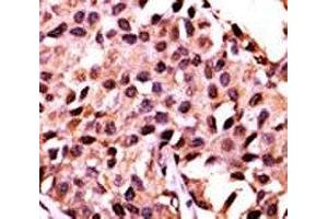 IHC analysis of FFPE human breast carcinoma stained with the PPP3CC antibody (PPP3CC Antikörper  (AA 18-47))