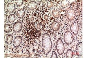 Immunohistochemical analysis of paraffin-embedded Human Colon Carcinoma Tissue using Epsilon Tubulin Mouse mAb diluted at 1:200. (TUBE1 Antikörper)