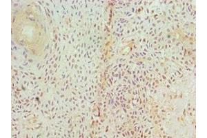 Immunohistochemistry of paraffin-embedded human breast cancer using ABIN7153952 at dilution of 1:100 (GAD Antikörper  (AA 1-200))