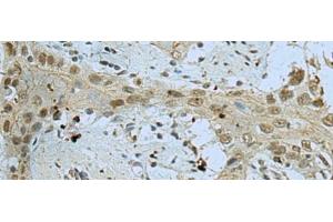 Immunohistochemistry of paraffin-embedded Human esophagus cancer tissue using WDR4 Polyclonal Antibody at dilution of 1:40(x200) (WDR4 Antikörper)