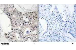Immunohistochemistry analysis of paraffin-embedded human breast carcinoma tissue using BAGE4 polyclonal antibody .