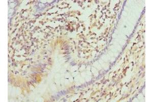 Immunohistochemistry of paraffin-embedded human colon cancer using ABIN7147369 at dilution of 1:100 (ITGB3BP Antikörper  (AA 1-177))