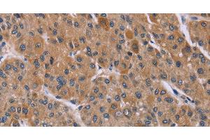 Immunohistochemistry of paraffin-embedded Human liver cancer using Cyclophilin F Polyclonal Antibody at dilution of 1:45 (PPIF Antikörper)
