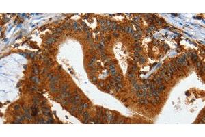 Immunohistochemistry of paraffin-embedded Human colon cancer tissue using IL20RA Polyclonal Antibody at dilution 1:35 (IL20RA Antikörper)