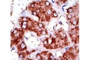 IHC analysis of FFPE human hepatocarcinoma tissue stained with the CPT1B antibody (CPT1B Antikörper  (AA 606-637))