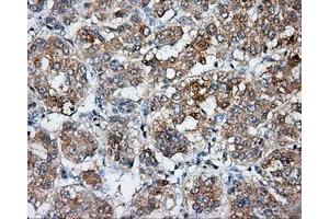 Immunohistochemical staining of paraffin-embedded Carcinoma of liver tissue using anti-BSG mouse monoclonal antibody. (CD147 Antikörper)