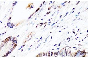 Immunohistochemistry of paraffin-embedded Human colon carcinoma using FGF12 Polyclonal Antibody at dilution of 1:150 (40x lens). (FGF12 Antikörper)