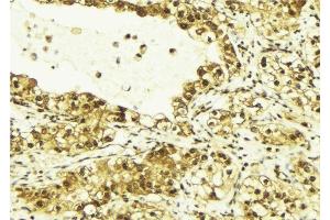 ABIN6269138 at 1/100 staining Human breast cancer tissue by IHC-P. (SRF Antikörper  (N-Term))