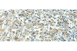 Immunohistochemistry of paraffin-embedded Human liver cancer tissue using FCGRT Polyclonal Antibody at dilution of 1:45(x200) (FcRn Antikörper)