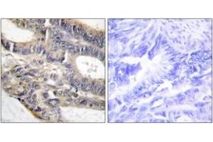 Immunohistochemistry analysis of paraffin-embedded human colon carcinoma tissue, using AS250 Antibody. (RALGAPA2 Antikörper  (AA 641-690))